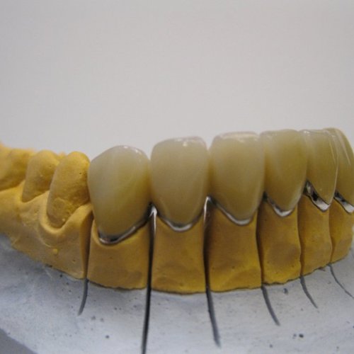 23 LP dental-fasetovaný můstek- kompozitní plast Chromasit.jpg