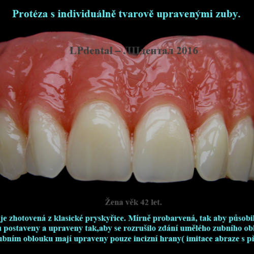 36 Protéza s individuálně tvarově upravenými zuby..png