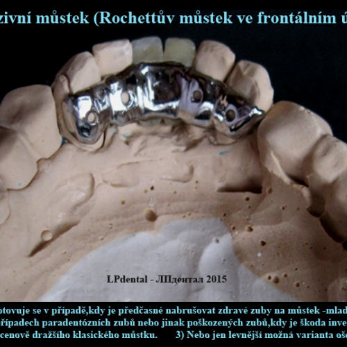 2 Adhezivní můstek (Rochettův můstek).png