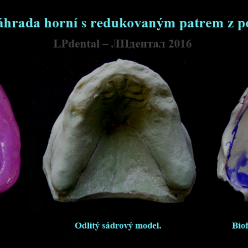 14 Celková snímatelná náhrada horní s redukovaným patrem z polyamidu Deflex M10..png