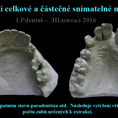 1 Imediální celkové a částečné snímatelné náhrady..png