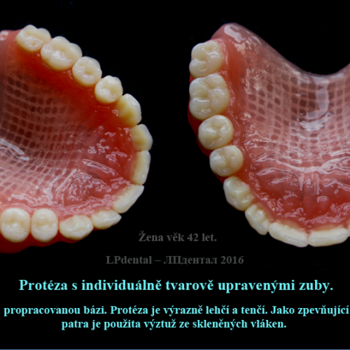 33 Protéza s individuálně tvarově upravenými zuby..png
