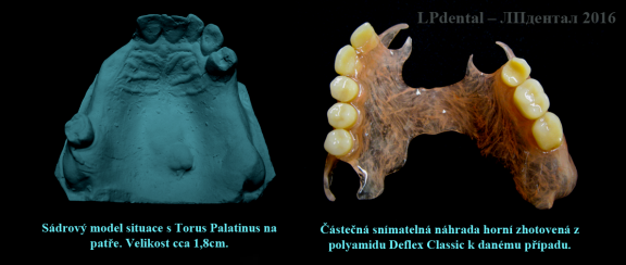 Torus Palatinus (pl.Tori Palatinus)-náhrada z polyamidu.Náhrada z polyamidu..png