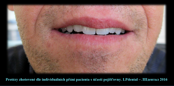 3 Protézy zhotovené dle individuálních přání pacienta s účastí pojišťovny..png