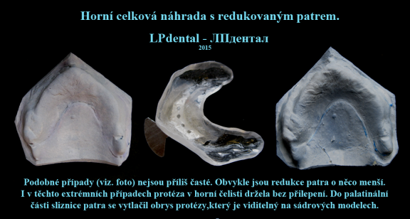 3 Horní celková náhrada s redukovaným patrem..png