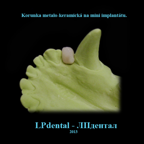 1 Mini implantáty-Мини импланты MDI (Mini Dental Implants)-metalokeramická korunka..png