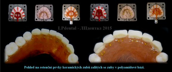 2 Polyamidová báze s keramickými zuby -Deflex Classic.png