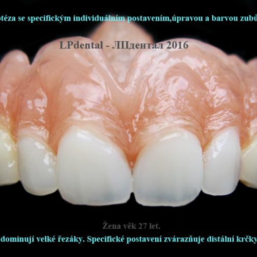 40 Protéza se specifickým individuálním postavením,úpravou a barvou zubů..png