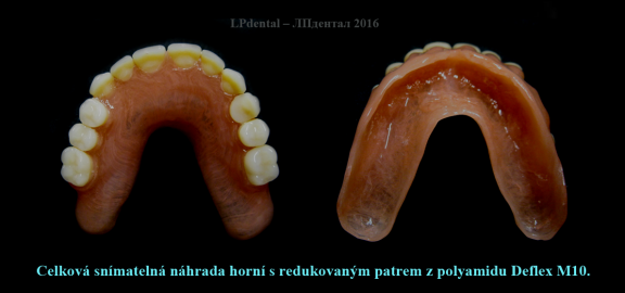 5 Horní celková snímatelná náhrada  s redukovaným patrem z polyamidu Deflex M10..png