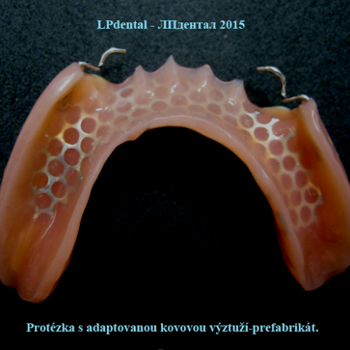 4 Zubní náhrada s individuálně upravenou výztuží..png
