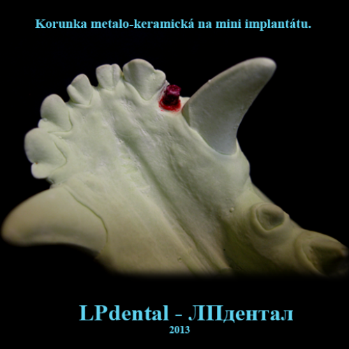 7 Mini implantáty-Мини импланты MDI (Mini Dental Implants)-metalokeramická korunka..png