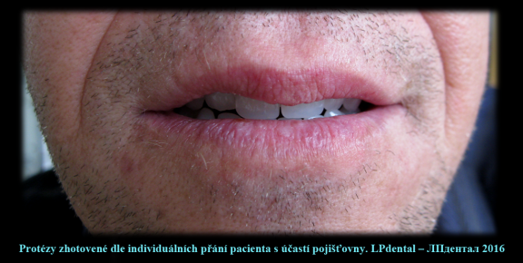 2 Protézy zhotovené dle individuálních přání pacienta s účastí pojišťovny..png