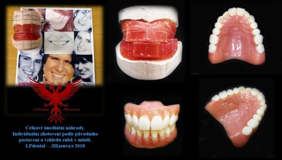 1 Celkové imediátní náhrady. Individuální zhotovení podle původního postavení a vzhledu zubů..jpg