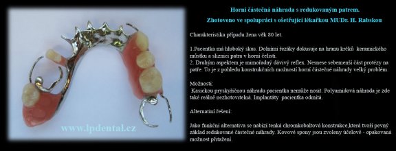 Horní částečná náhrada s redukovaným patrem z klasické pryskyřice.