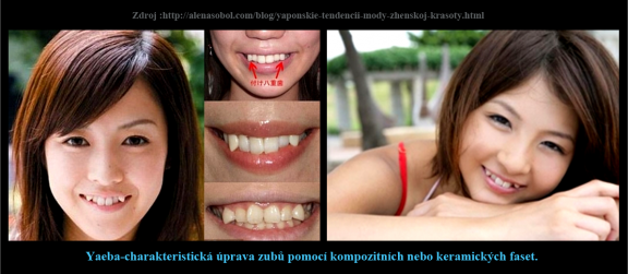 1 Yaeba-charakteristická úprava zubů pomocí kompozitních nebo keramických faset..png