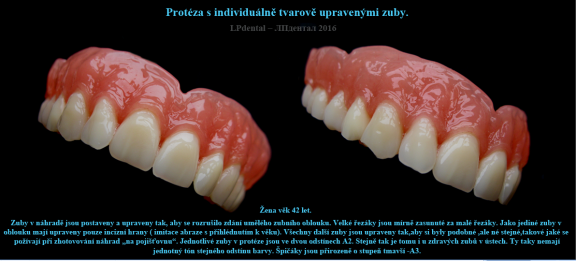 18-1 Protéza s individuálně tvarově upravenými zuby...png