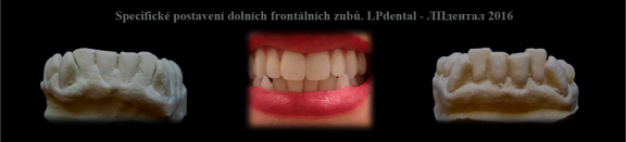 Specifické postavení dolních frontálních zubů.