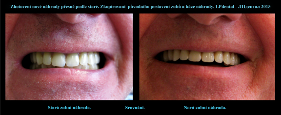 7 Porovnání původní a nové zubní náhrady v ústech pacienta..png