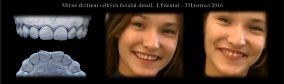 Mírné zkřížení velkých řezáků.