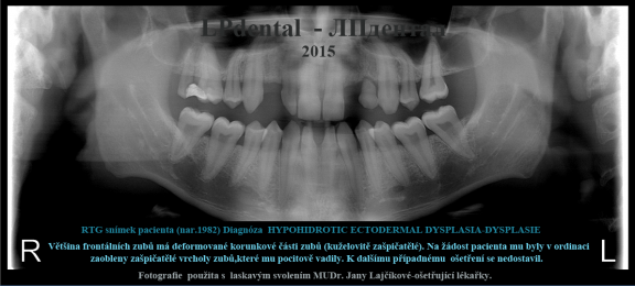 HYPOHIDROTIC ECTODERMAL DYSPLASIA-DYSPLASIE.png