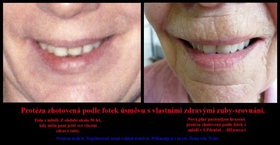 3 Protéza nedrží. Nepřirozeně mění vzhled úsměvu. Přikusuji si s ní ret. Žena věk 79.jpg