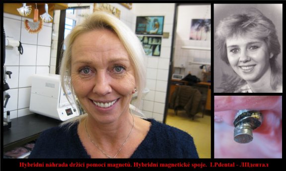 Hybridní náhrada držící pomocí magnetů. Hybridní magnetické spoje..jpg