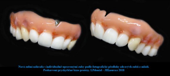 Horní celková hybridní náhrada-fixace systém Locator -nová náhrada 9.jpg