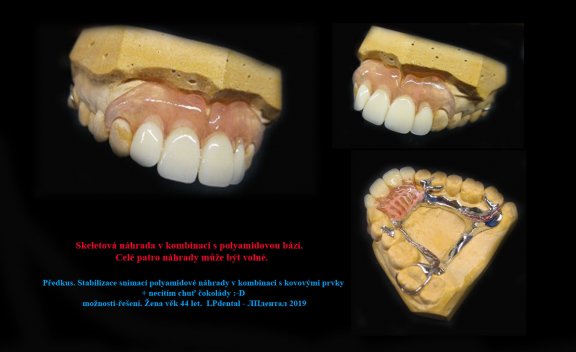 6 Předkus. Stabilizace snímací polyamidové náhrady v kombinaci s kovovými prvky 