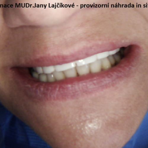 7 provizorní můstek z plastu.png