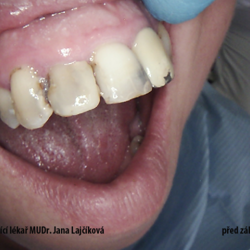 18  MUDr.Jana Lajčíková-Petr Moj- LPdental-keramika NORITAKE ノリタケ.png