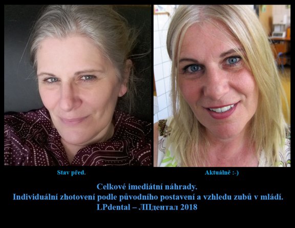 Stav před zhotovením náhrad a následně s novými zubními náhradami.