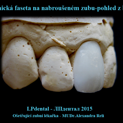O- Keramická faseta-pohled z boku.png