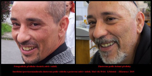 2 Imediátní (provizorní)náhrada zhotovená podle vzhledu a postavení zubů v mládí. Muž věk 50 let..jp