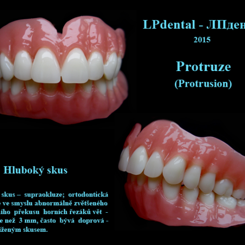 16 Totální protézy-Protruze-Hluboký skus-Acryl Pol-R.png