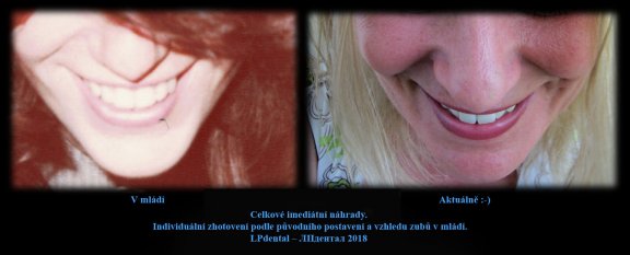 5 Celkové imediátní náhrady. Individuální zhotovení podle původního postavení a vzhledu zubů..jpg