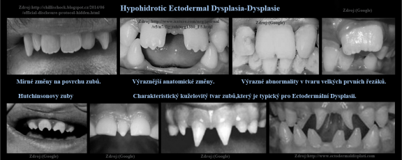 14 Hypohidrotic Ectodermal Dysplasia.png