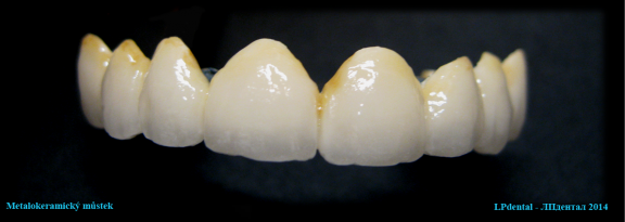 Metalokeramický můstek LPdental (ЛПдентал).png