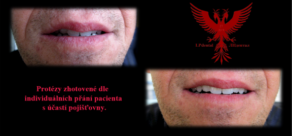 Protézy zhotovené dle individuálních přání pacienta s účastí pojišťovny...png