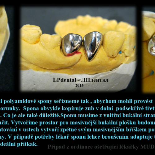 30 Nahrazení pilířového zubu celolitou korunkou..png
