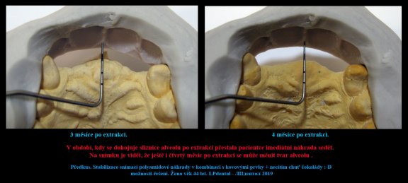 2 Předkus. Stabilizace snímací polyamidové náhrady v kombinaci s kovovými prvky 