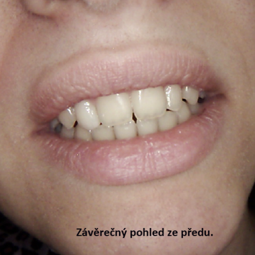 7 Estetická faseta z kompozitního plastu.png