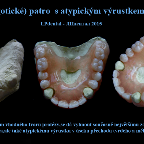 15-1 Bezkovová snímatelná náhrada z Deflexu.png