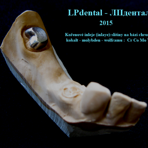 09-2  inlay kořenová 3 kanálky-nepřímá litá.png