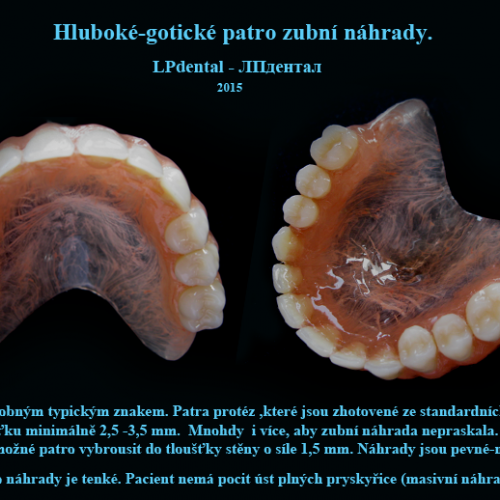 18-31 Bezkovová snímatelná náhrada z Deflexu.png