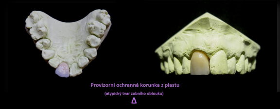 provizorní ochranná korunka z plastu.png