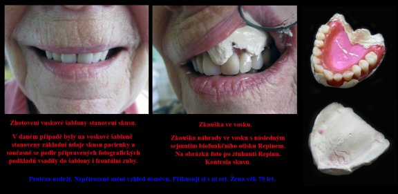 4 Protéza nedrží. Nepřirozeně mění vzhled úsměvu. Přikusuji si s ní ret. Žena věk 79.jpg
