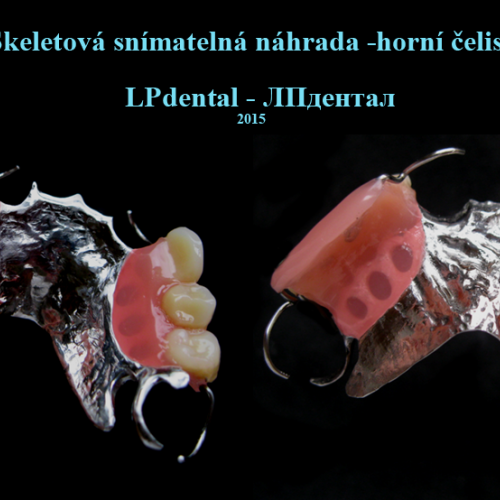 05-1 Skeletová snímatelná náhrada-horní čelist..png