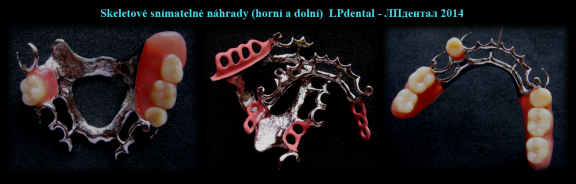 Skeletové snímatelné náhrady.png