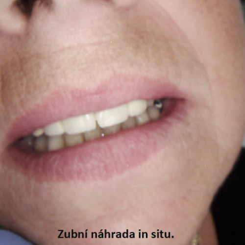 18 Provizorní ochranné korunky z plastu..png