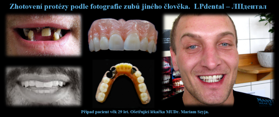 Dolní částečná snímatelná náhrada z Deflexu Classic.